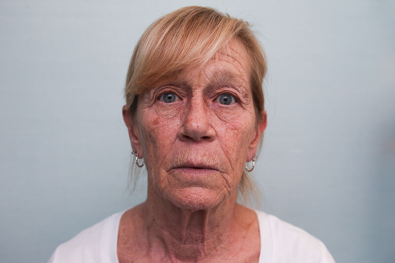 Facelift Before & After Patient Photo