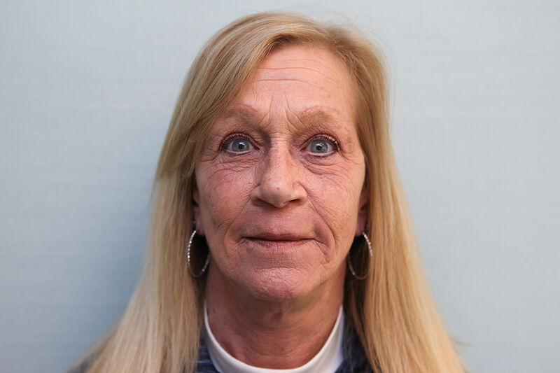 Facelift Before & After Patient Photo