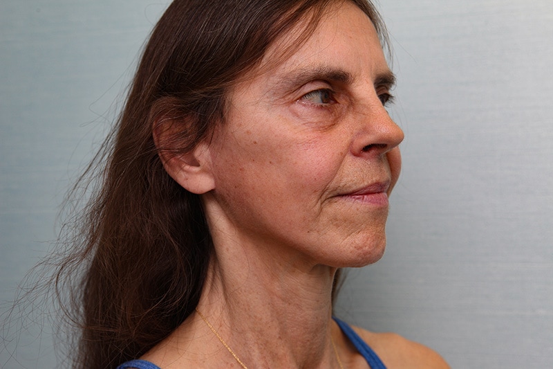 Jawline-Refine Before & After Patient Photo