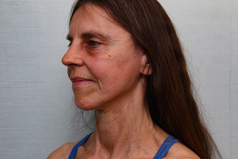 Jawline-Refine Before & After Patient Photo