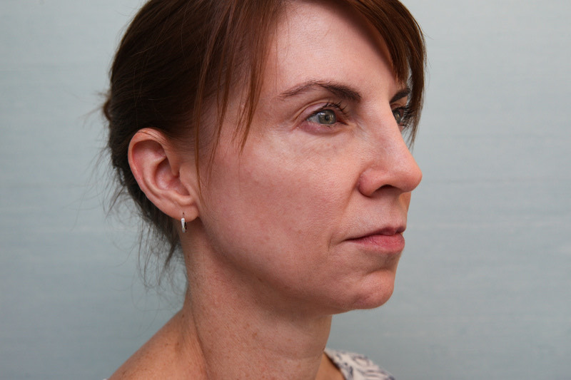Jawline-Refine Before & After Patient Photo