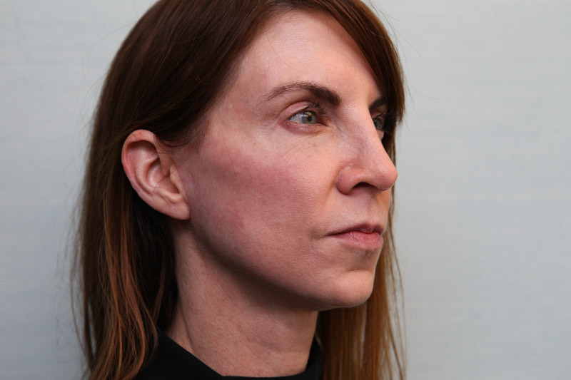 Jawline-Refine Before & After Patient Photo