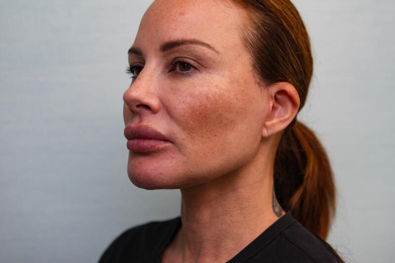 Jawline-Refine Before & After Patient Photo