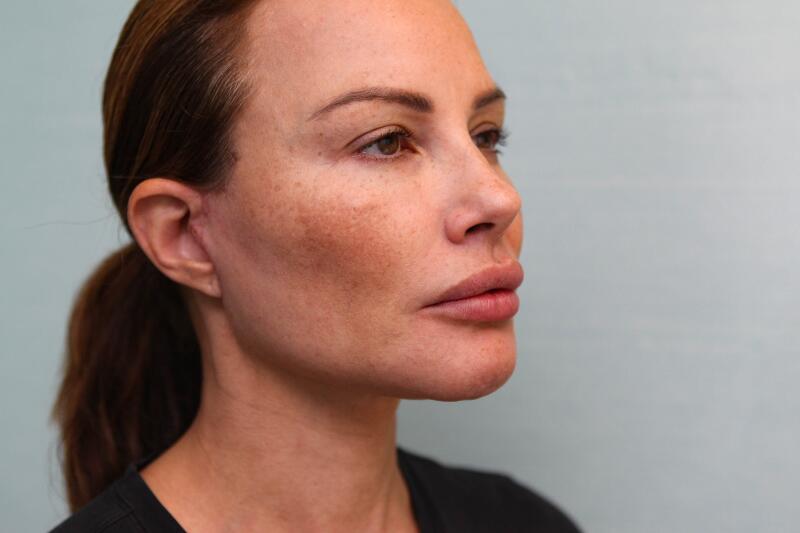 Jawline-Refine Before & After Patient Photo