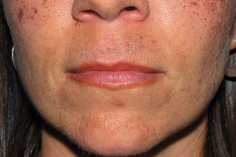 Lip Augmentation Before & After Patient Photo