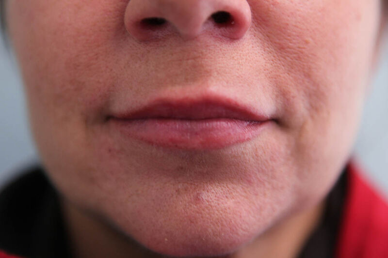 Lip Augmentation Before & After Patient Photo