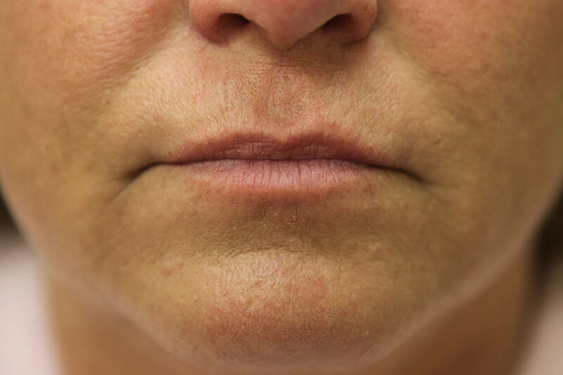 Lip Augmentation Before & After Patient Photo