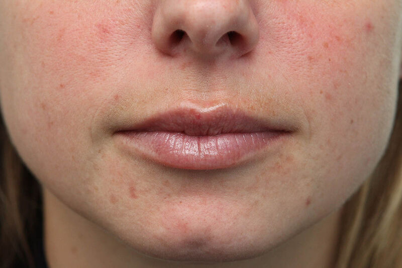 Lip Augmentation Before & After Patient Photo