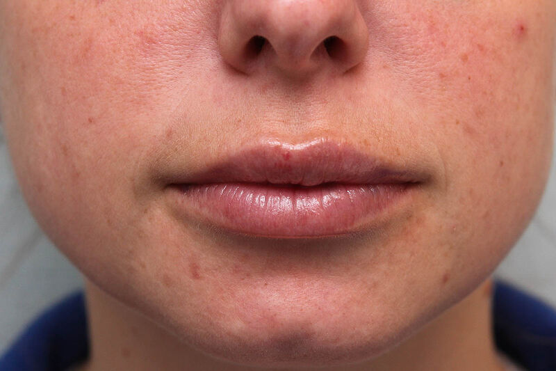 Lip Augmentation Before & After Patient Photo