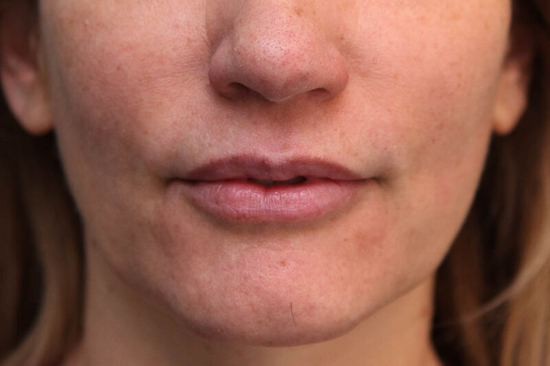 Lip Augmentation Before & After Patient Photo