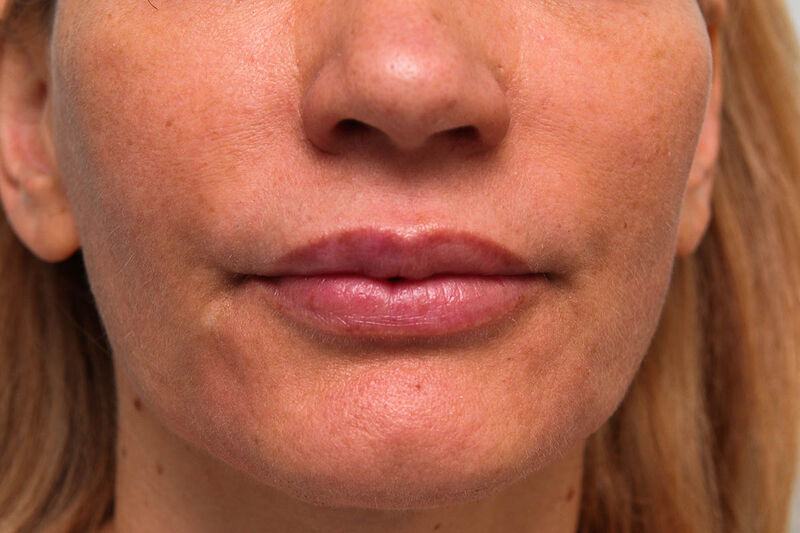 Lip Augmentation Before & After Patient Photo