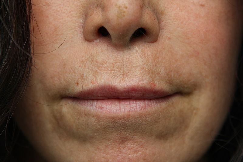 Lip Lift Before & After Patient Photo