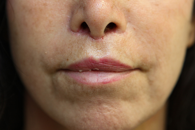 Lip Lift Before & After Patient Photo
