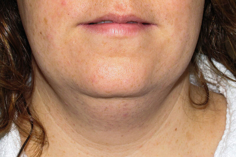 Liposuction Neck Before & After Patient Photo