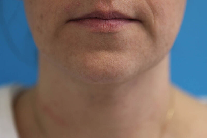 Liposuction Neck Before & After Patient Photo