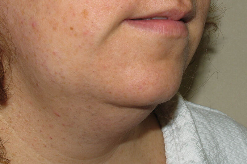 Liposuction Neck Before & After Patient Photo