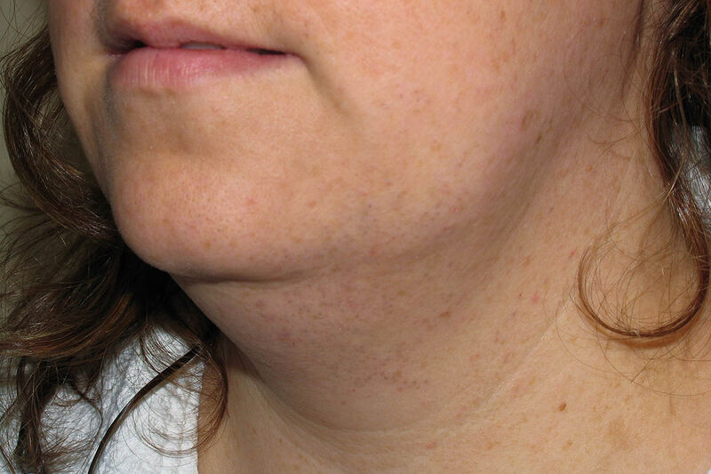 Liposuction Neck Before & After Patient Photo