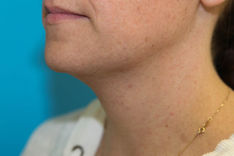 Liposuction Neck Before & After Patient Photo