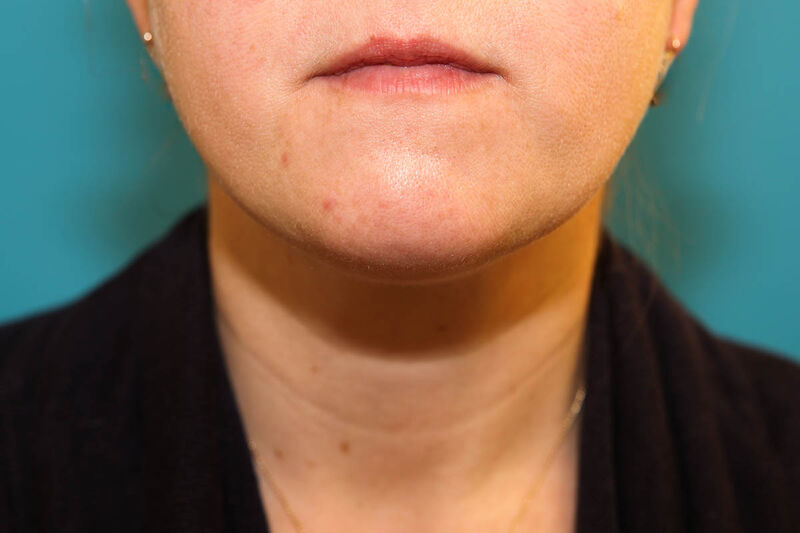 Liposuction Neck Before & After Patient Photo