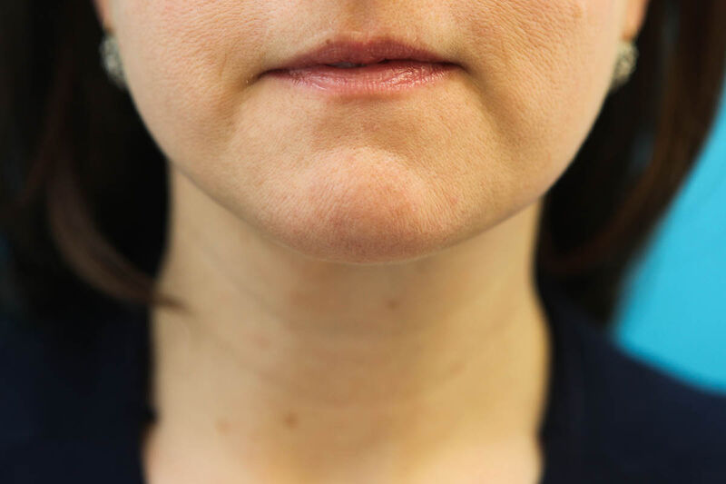 Liposuction Neck Before & After Patient Photo