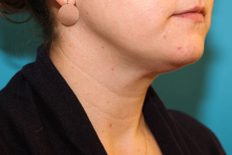 Liposuction Neck Before & After Patient Photo