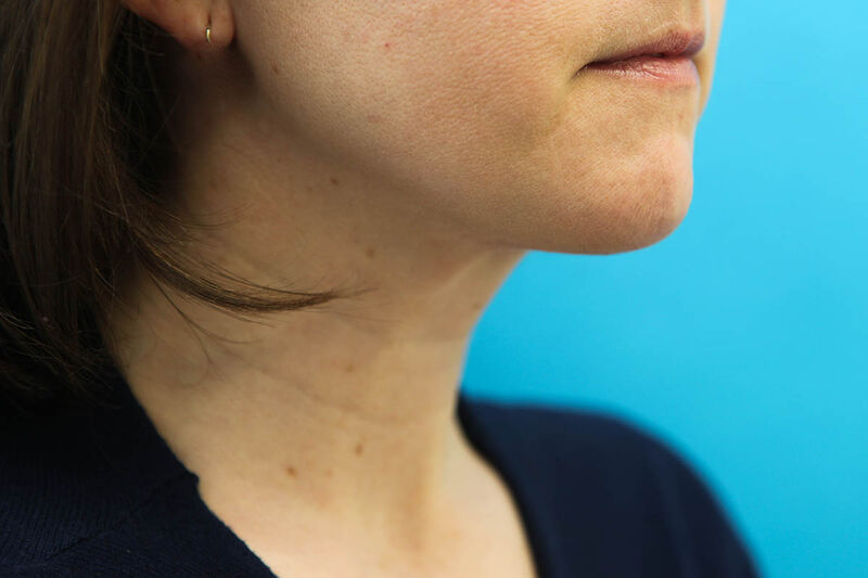 Liposuction Neck Before & After Patient Photo