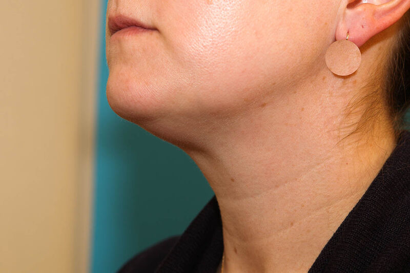 Liposuction Neck Before & After Patient Photo