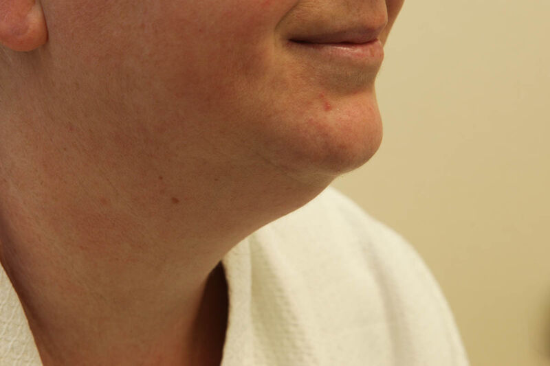 Liposuction Neck Before & After Patient Photo