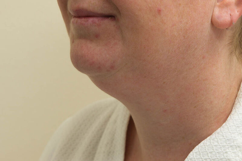 Liposuction Neck Before & After Patient Photo