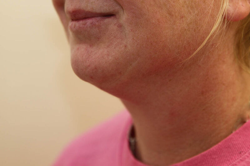 Liposuction Neck Before & After Patient Photo