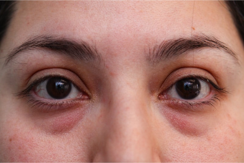 Lower Blepharoplasty Before & After Patient Photo