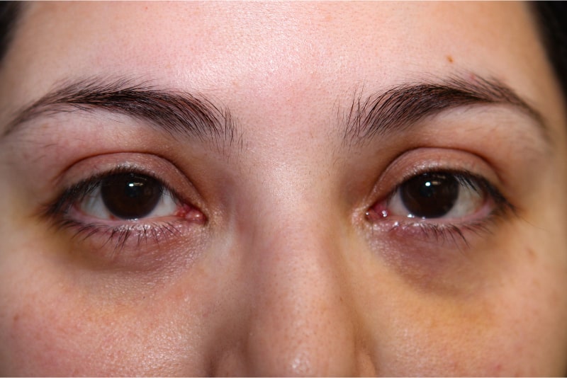 Lower Blepharoplasty Before & After Patient Photo