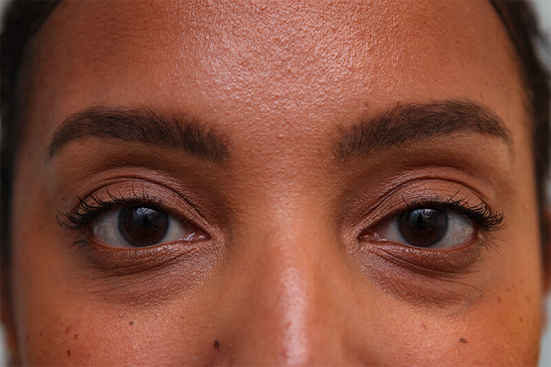 Lower Blepharoplasty Before & After Patient Photo