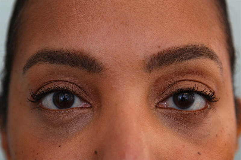 Lower Blepharoplasty Before & After Patient Photo