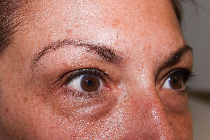 Lower Blepharoplasty Before & After Patient Photo