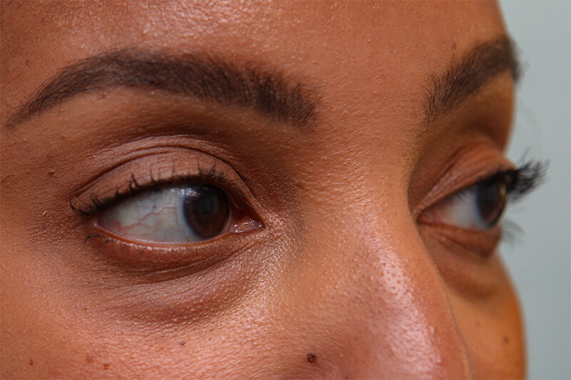 Lower Blepharoplasty Before & After Patient Photo