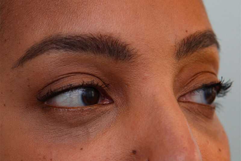 Lower Blepharoplasty Before & After Patient Photo