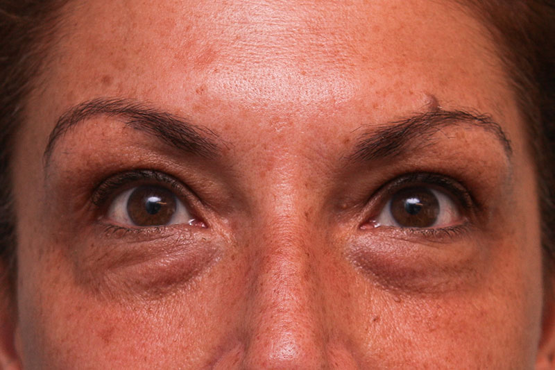 Lower Blepharoplasty Before & After Patient Photo