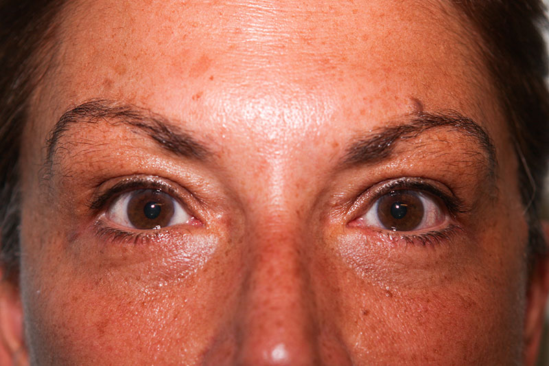 Lower Blepharoplasty Before & After Patient Photo