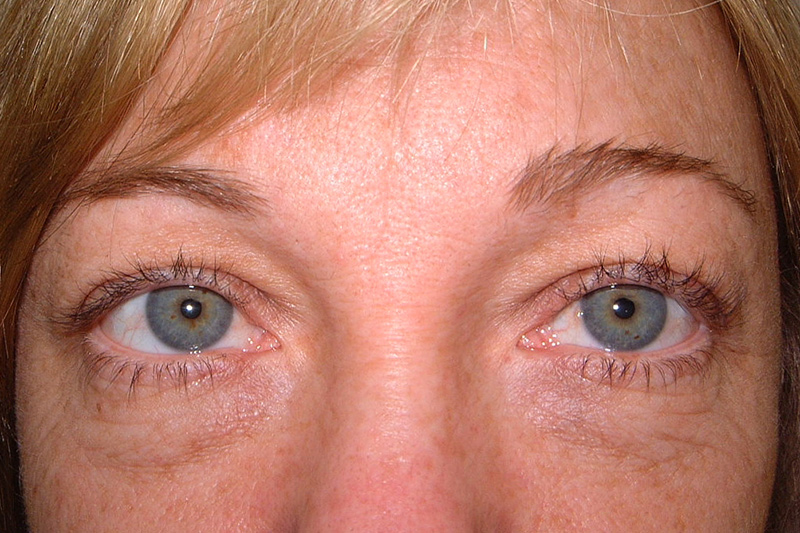 Lower Blepharoplasty Before & After Patient Photo