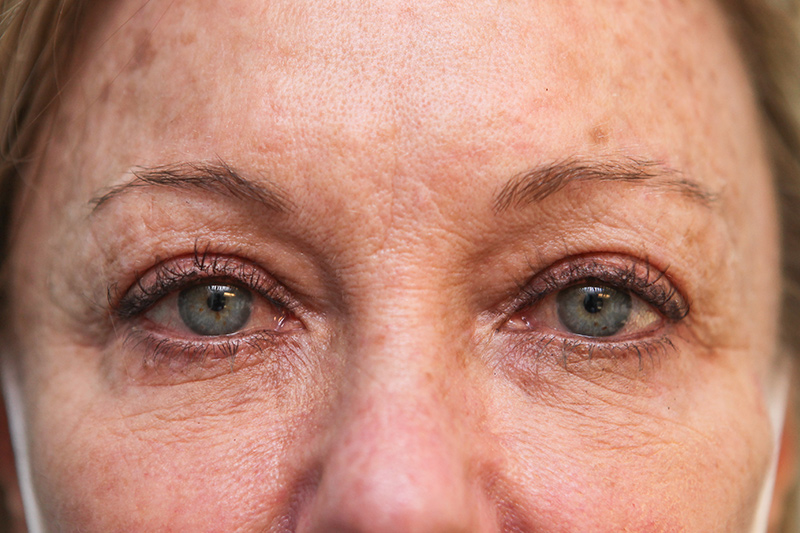 Lower Blepharoplasty Before & After Patient Photo