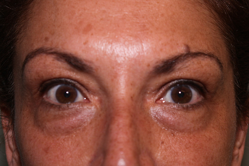 Lower Blepharoplasty Before & After Patient Photo