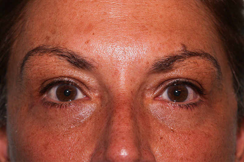 Lower Blepharoplasty Before & After Patient Photo