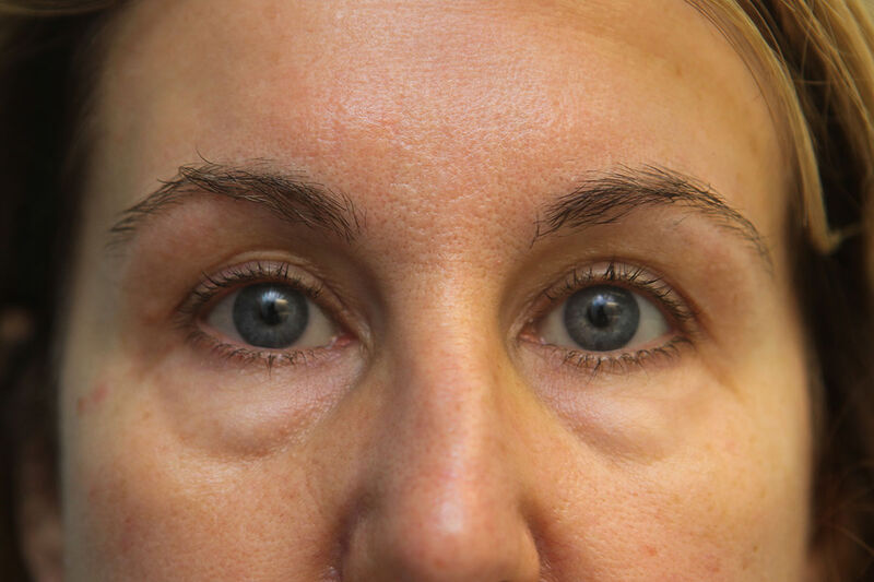 Lower Blepharoplasty Before & After Patient Photo