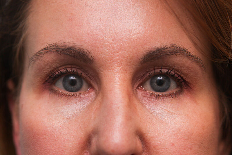 Lower Blepharoplasty Before & After Patient Photo