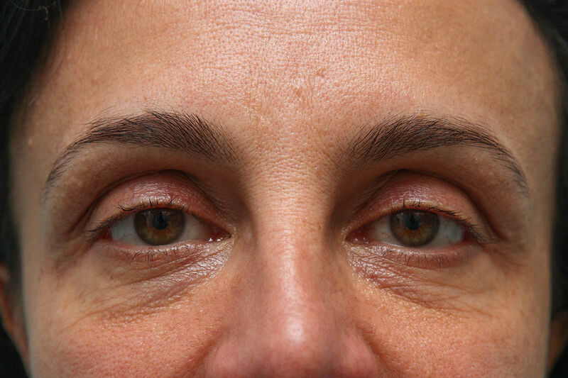 Lower Blepharoplasty Before & After Patient Photo