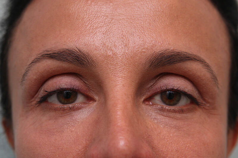 Lower Blepharoplasty Before & After Patient Photo