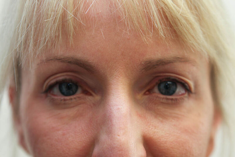 Lower Blepharoplasty Before & After Patient Photo