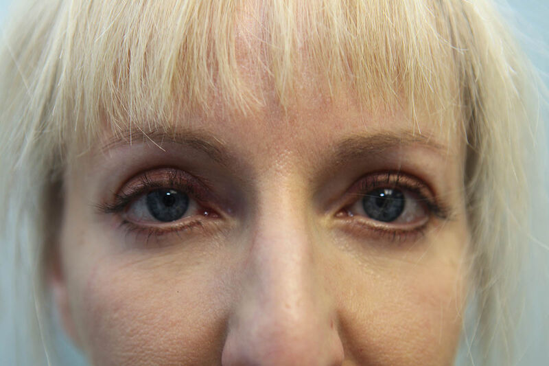 Lower Blepharoplasty Before & After Patient Photo