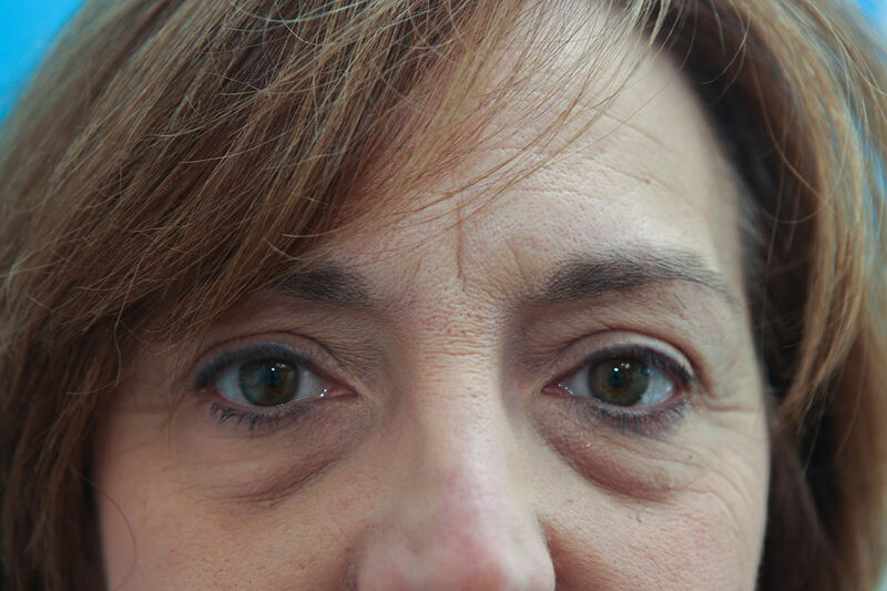 Lower Blepharoplasty Before & After Patient Photo